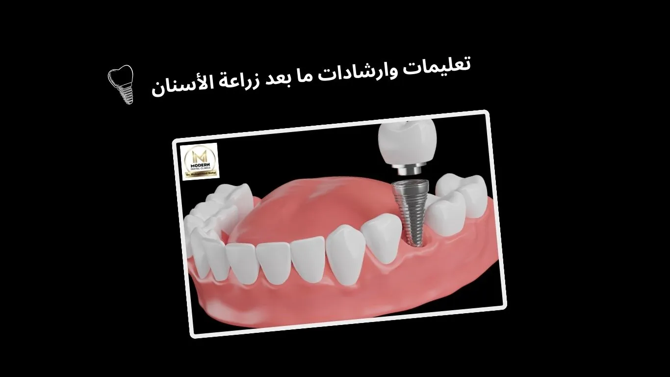 ما بعد زراعة الاسنان