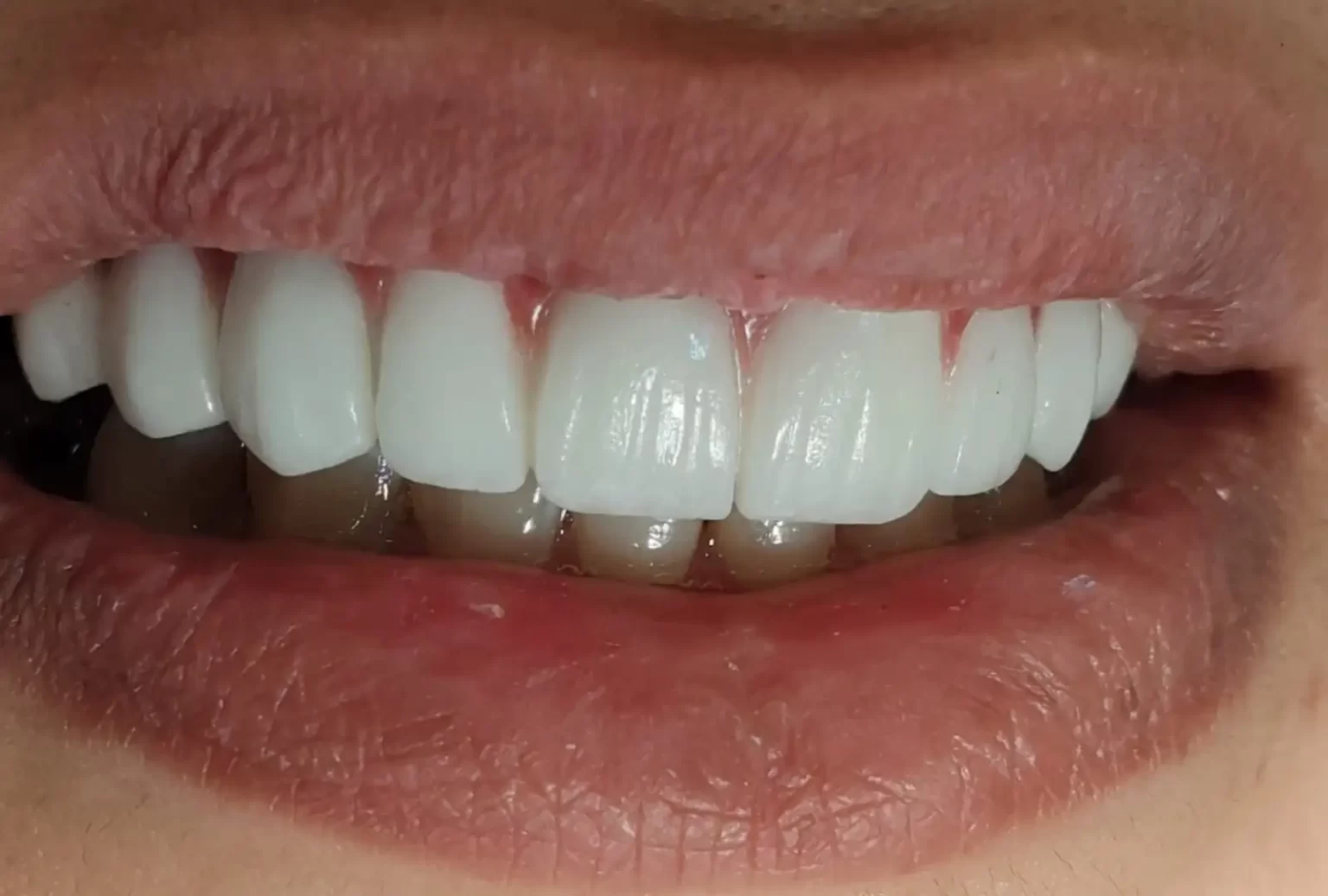 فوائد تجميل الأسنان: أكثر من مجرد مظهر جميل!
