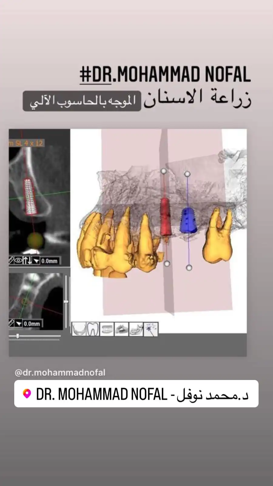 مميزات زراعة الأسنان الفورية: هل هي الخيار المناسب لك؟