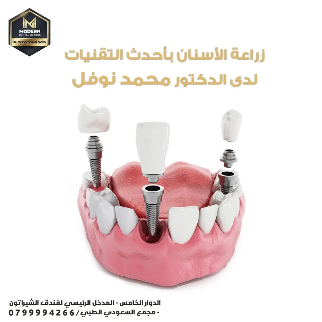 التقنيات الحديثة في زراعة الأسنان: تطورات مذهلة تحسن نتائج العلاج