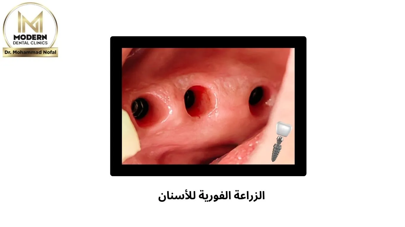 الزراعة الفورية للاسنان