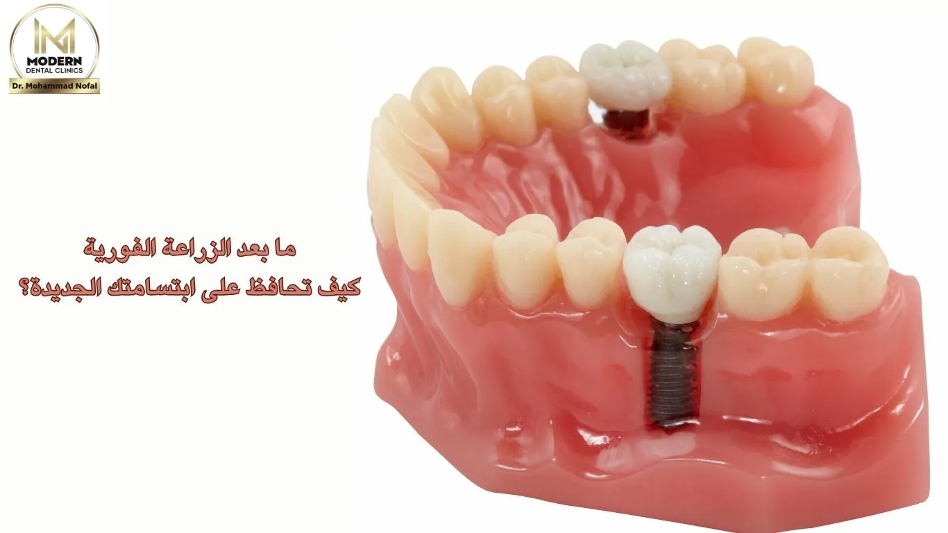 ما بعد الزراعة الفورية: كيف تحافظ على ابتسامتك الجديدة؟