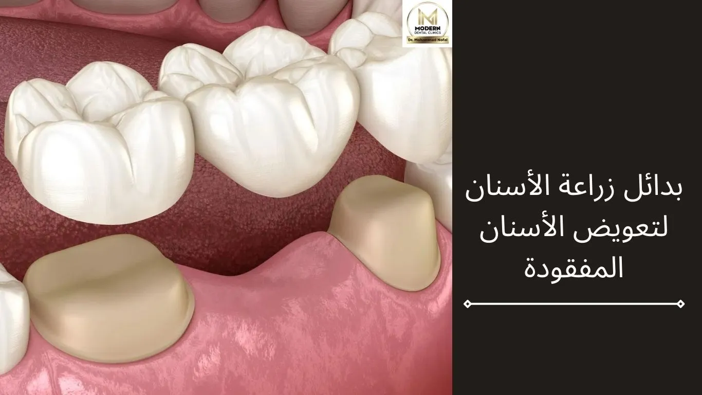 ما هي بدائل زراعة الاسنان لتعويض الأسنان المفقودة؟