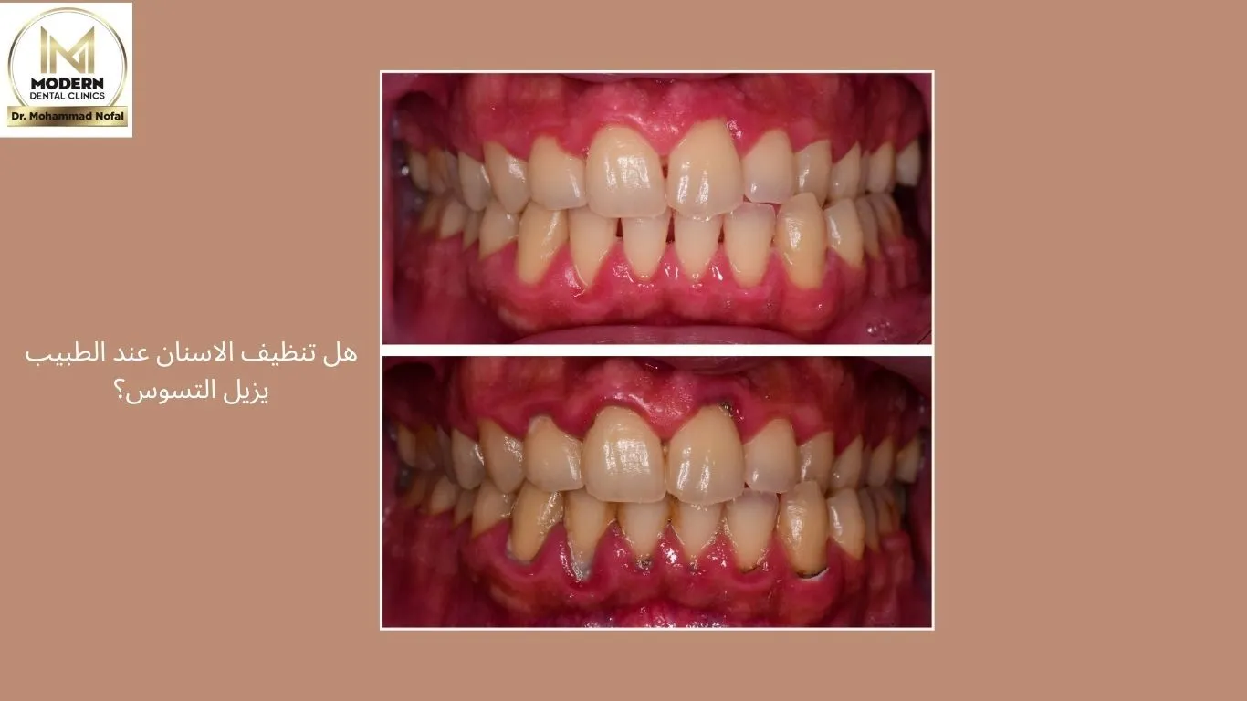 هل تنظيف الاسنان عند الطبيب يزيل التسوس