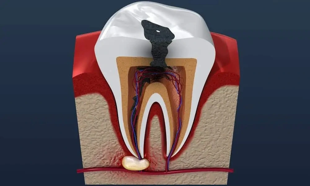خراج السن: أسبابه و طرق علاجه