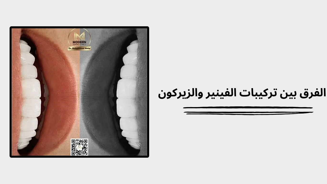 الفينير والزيركون في ابتسامة هوليود: ما الفرق؟