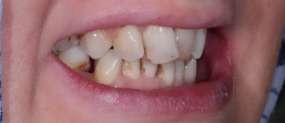 قبل