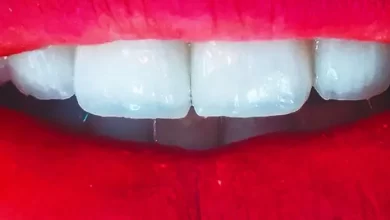 فينيرز الأسنان