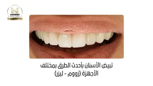 تبيض الأسنان بأحدث الطرق بمختلف الأجهزة (زووم - ليزر) 